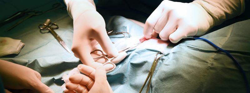 Advanced Surgical Techniques for Pilonidal Cyst Removal in 2025
